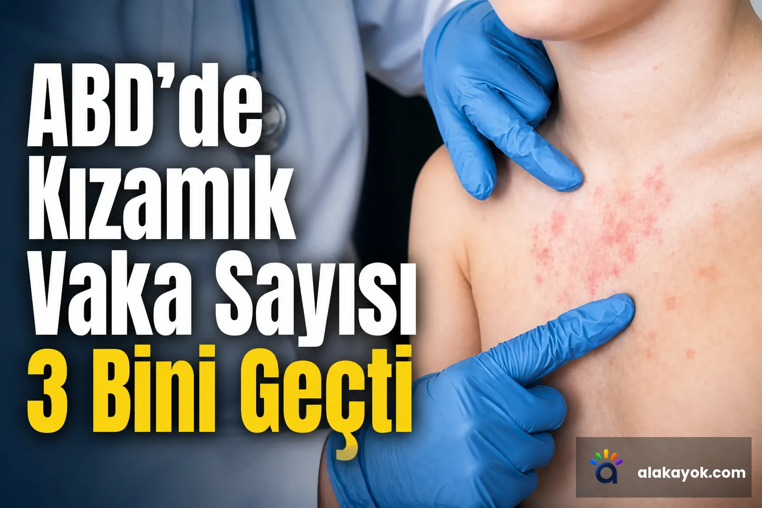 ABD'de Kızamık Vaka Sayısı 3 Bini Geçti