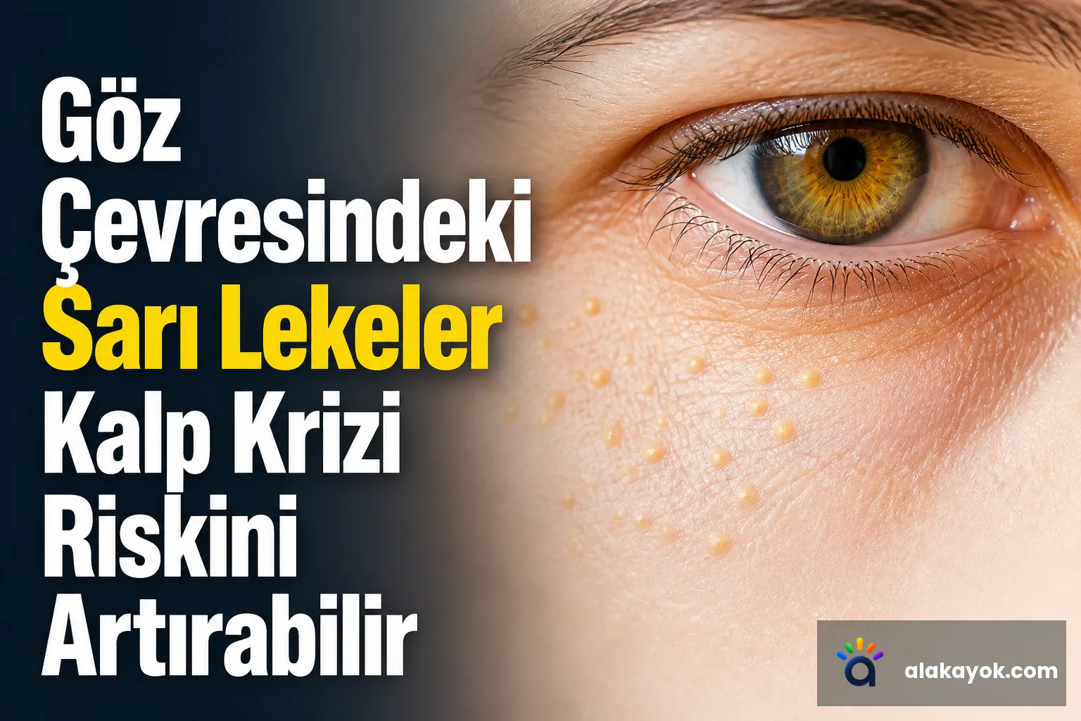 Göz Çevresindeki Sarı Lekeler Kalp Krizi Riskini Artırabilir